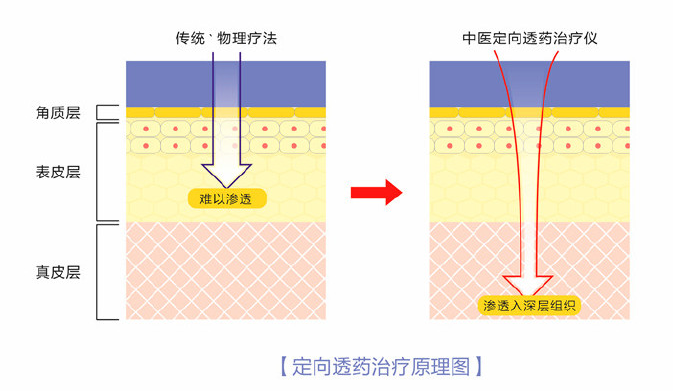 弘億康中醫定向透藥治療儀療法對比